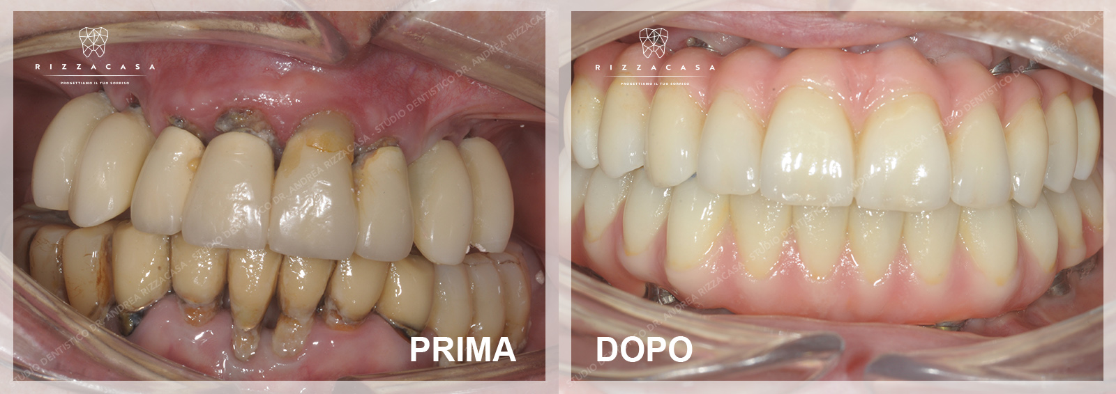 Implantologia All on Four Monza e Brianza - Studio Dentistico Rizzacasa